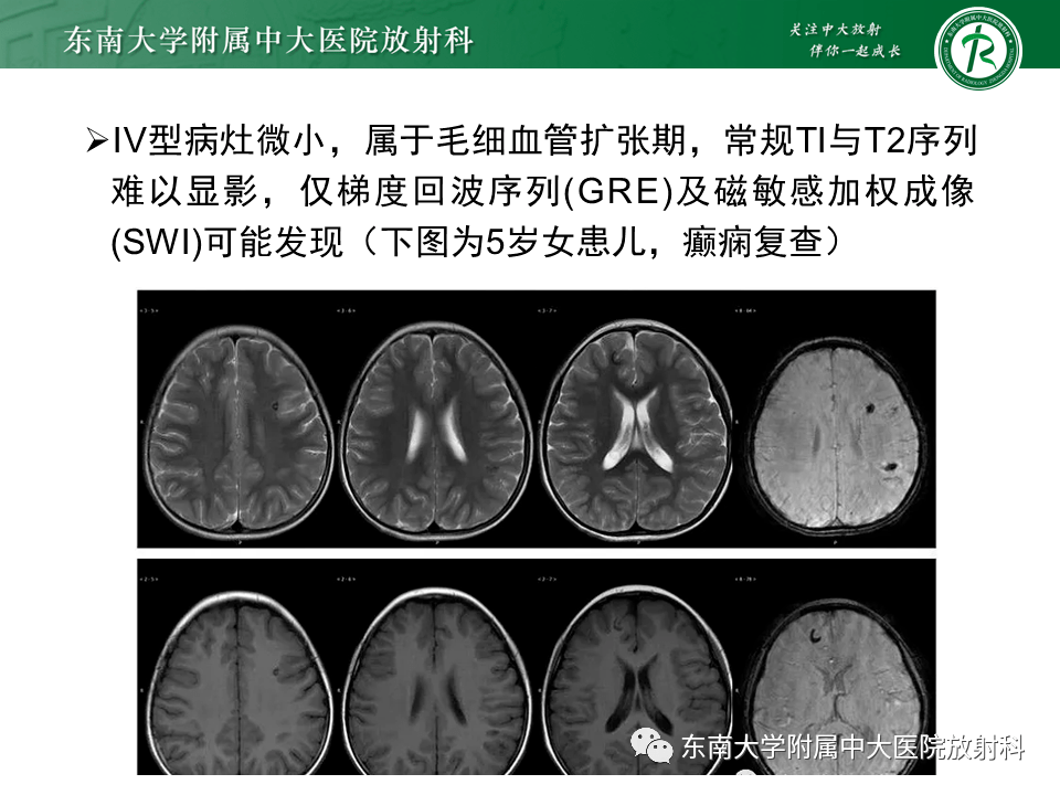 脉络膜血管瘤的最新治疗方法-“探索脉络膜血管瘤创新治疗方案”